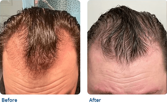 Hair Loss: Before and After