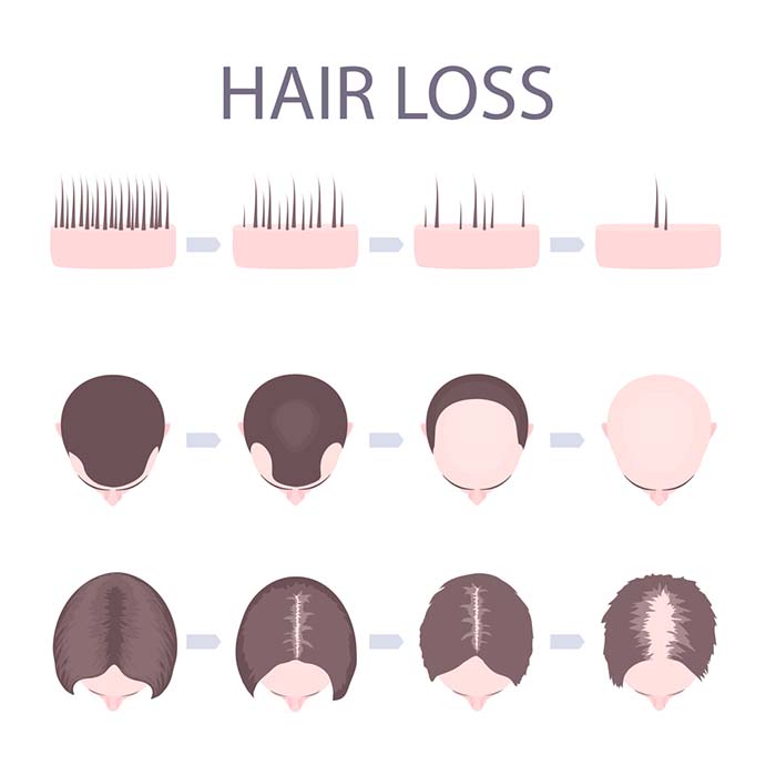 Hair Loss