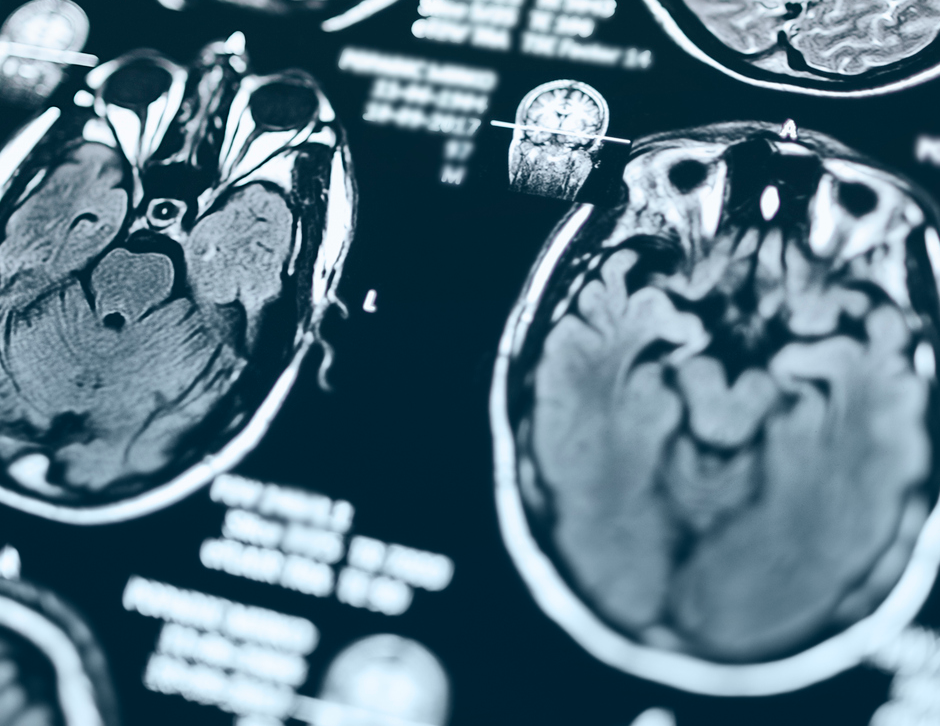 Important Lessons from the EVOKE Alzheimer’s Clinical Trial with Oral Semaglutide 