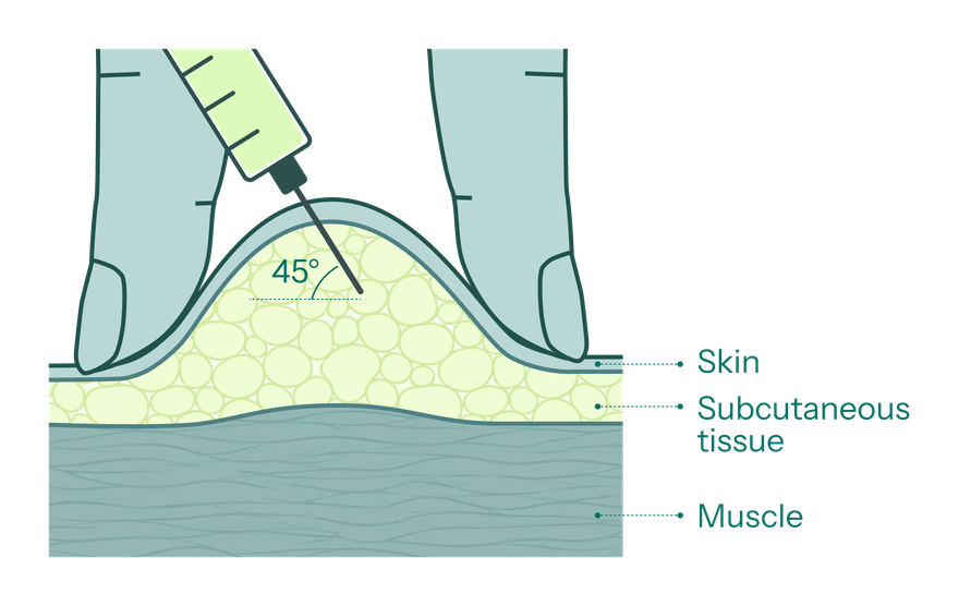 Cross-section of a subcutaneous injection: the needle enters the fatty layer beneath the skin at a 45 degree angle, above the muscle.